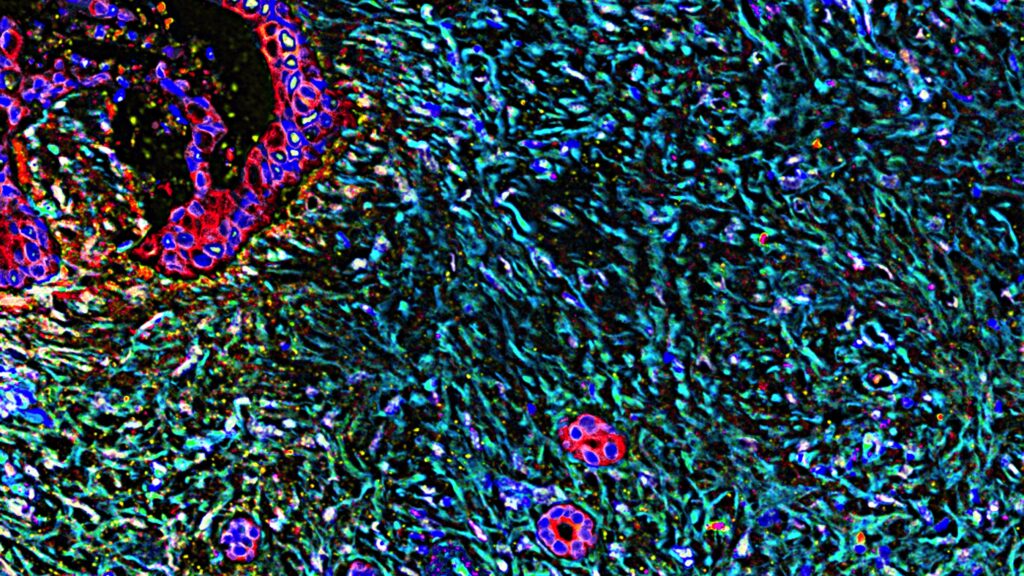 STAT+: A pancreatic cancer expert on why Revolution Medicines’ study could ‘open up a new era’ of treatment