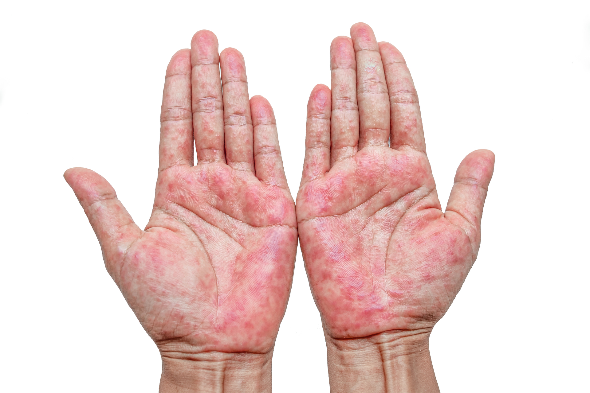 Atopic dermatitis rash on palms