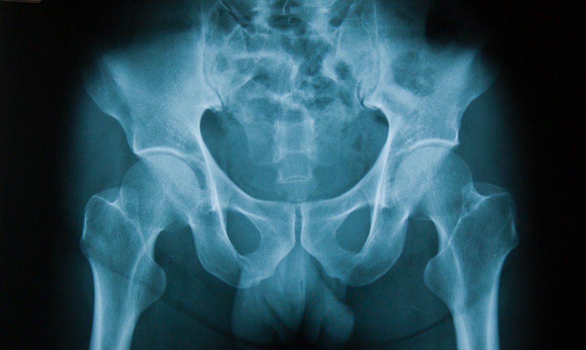 Hip x-ray