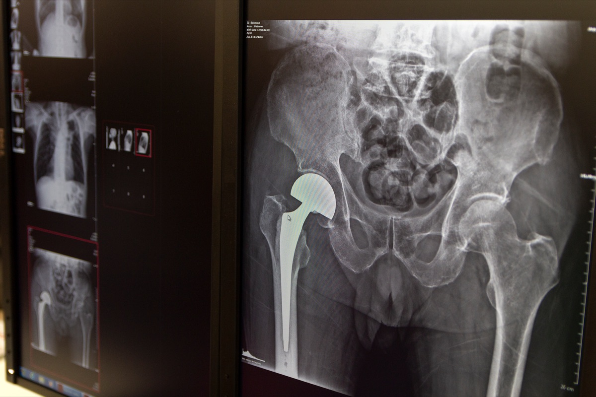 Hip x-ray