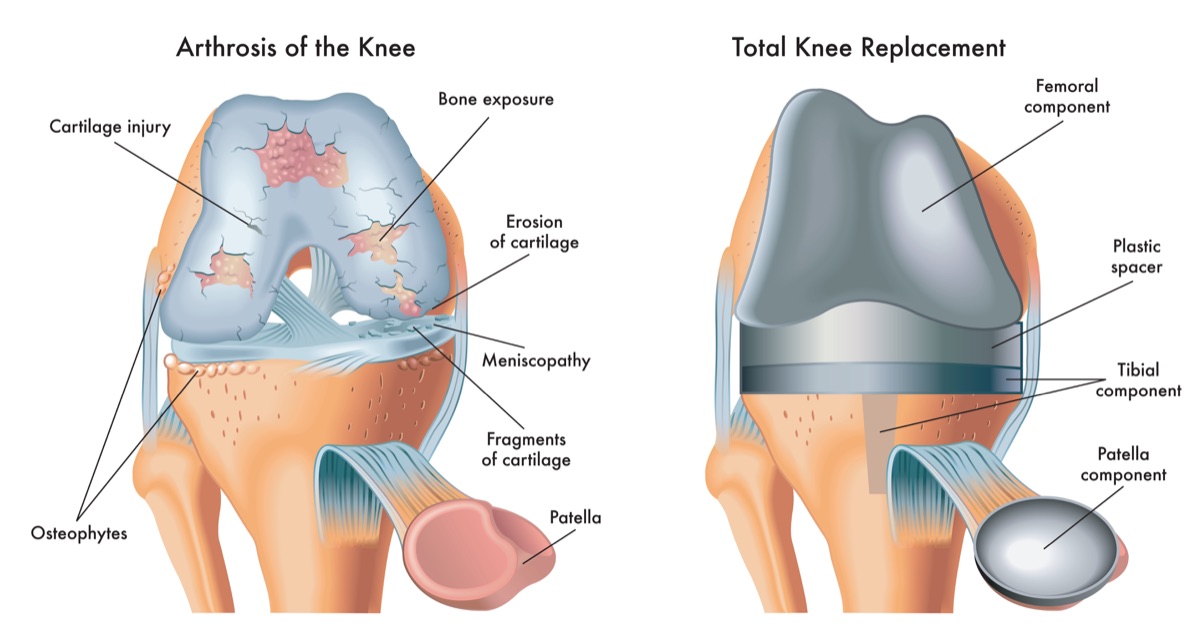Arthrosis vs knee replacement