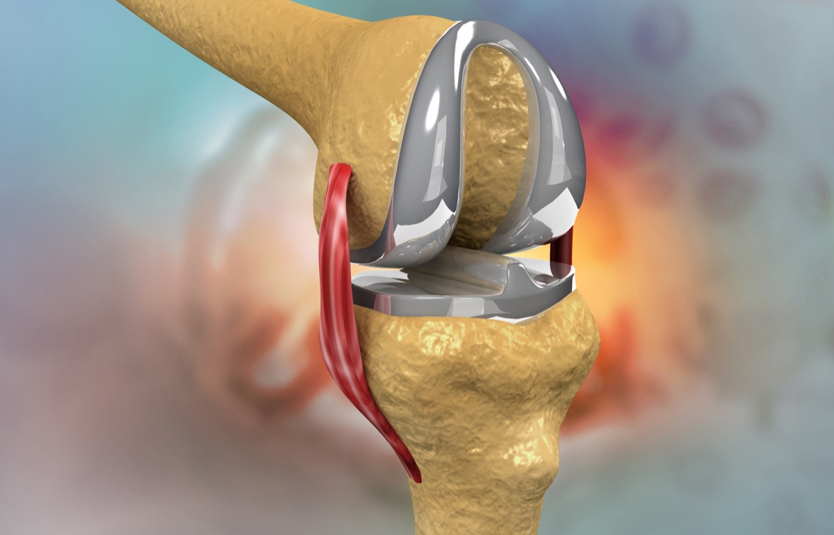 3D illustration of knee implant