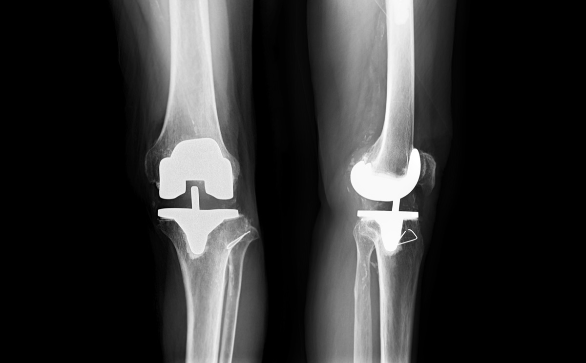 X-ray view of knee replacement