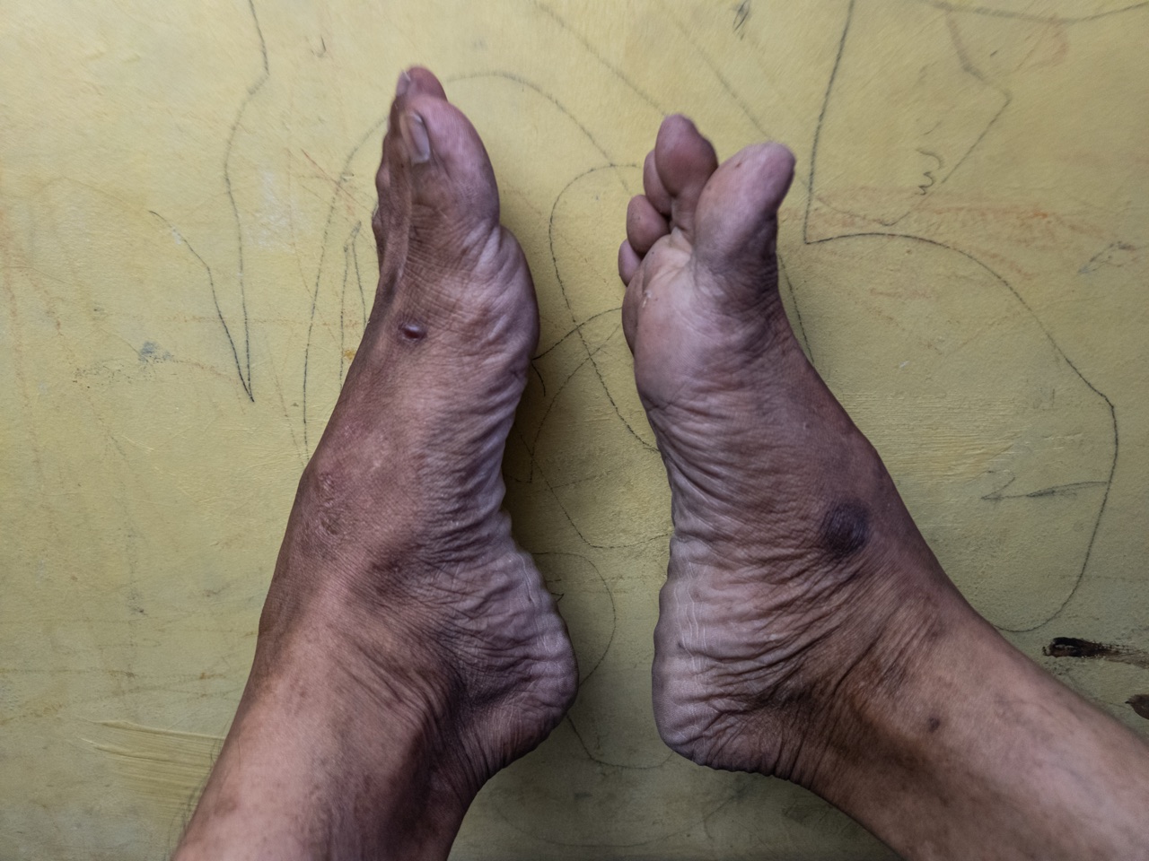 Foot detail showing neuropathy symptoms at night